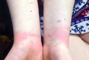 Mãe se revolta depois de policiais algemarem e ferirem sua filha autista com capacidade mental de uma criança de 5 anos